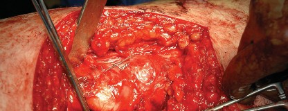 Illustration 102 for Femoral Stem Revision: Posterior Approach for Better Outcomes