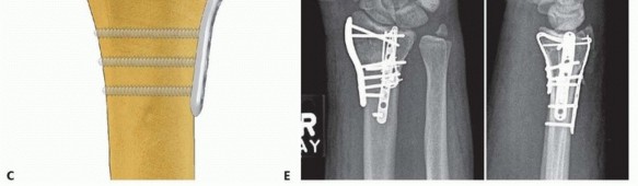 Illustration 37 for Fragment-Specific Fixation: Restore Carpal Facet Horizon