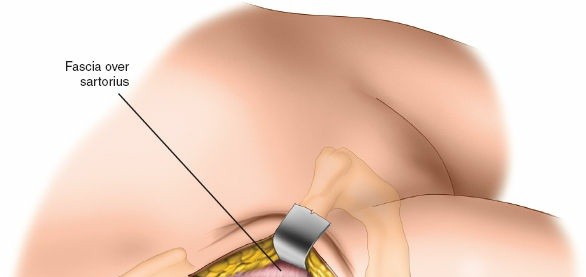 Illustration 83 for Unlocking Every Aspect of the Hip's Surgical Approaches