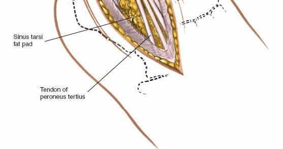Illustration 93 for Optimized Approaches to the Dorsum of the Foot & Ankle