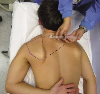 التهاب الجراب الكتفي الصدري الألم الخفي الذي يقلد إصابات المرفق