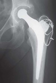 Illustration 19 for Mastering Hip Arthroplasty: Its Evolution and Design Unveiled