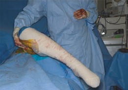 Illustration 7 for Open Hip Dislocation: How Fascia Lata Autograft Restores Stability