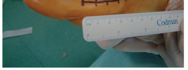 Illustration 8 for Mastering the Biplanar Distal Chevron for Effective Bunion Surgery