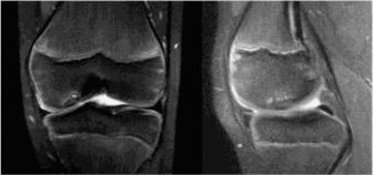 Illustration 2 for Pediatric OCD: When to Consider Drilling for the Femoral