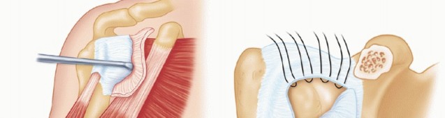 Illustration 15 for Glenoid Bone Graft for Anterior Shoulder Instability: Restore Stability