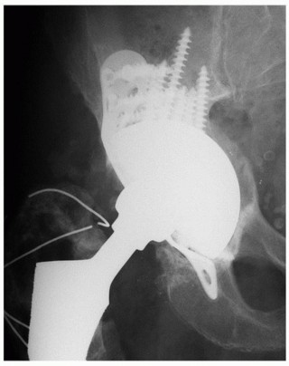 Illustration 18 for Uncemented Acetabular Component: Augments & Cup-Cages for Bone Loss