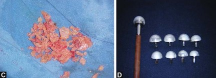 Illustration 31 for Total Hip Replacement for Protrusio: Restore Your Hip Function
