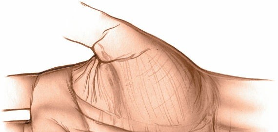 Illustration of medial midpalmar space - Dr. Mohammed Hutaif