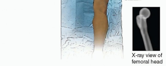 Illustration 9 for Knee Arthrodesis: A Solution for Stable Femur & Tibia Fusion