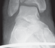 Illustration 32 for Optimizing ORIF for Tibial Plafond Fractures: A Modern Approach