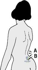 Prolapsed Intervertebral Disc: Understanding Your Spinal Anatomy