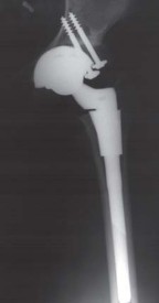 Illustration 105 for Successful Total Hip Replacement in Developmental Dysplasia