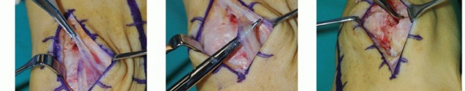 Illustration 3 for Mastering Midfoot Arthrodesis: Protect the Deep Neurovascular Bundle