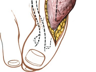 Illustration 196 for Optimized Approaches to the Dorsum of the Foot & Ankle