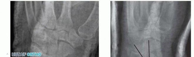 Illustration 3 for Distal Radius Fixation: Precision Through Lister's Tubercle