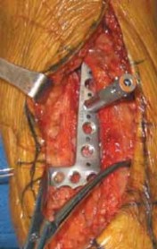 Illustration 47 for Optimizing ORIF for Tibial Plafond Fractures: A Modern Approach