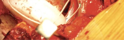 Illustration 65 for Birmingham Hip Resurfacing Designer's Technique for Active Lives