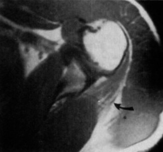 Illustration 2 for Unraveling Axillary Nerve Mystery in Elbow Cases