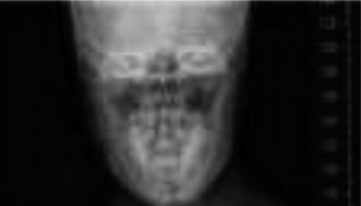 Illustration 2 for Pediatric Scoliosis: When Curves Are Larger Than Degrees, What's Next?