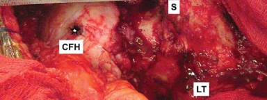 صورة طبية: إتقان توازن الأنسجة الرخوة لمفصل ورك صناعي مثالي: دليل شامل للمرضى مع الأستاذ الدكتور محمد هطيف