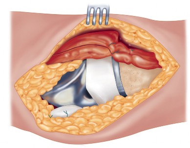 Illustration 41 for Precision Soft Tissue Balancing in Revision: Avoid TKA Pitfalls