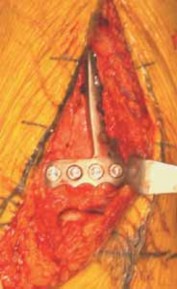 Illustration 46 for Optimizing ORIF for Tibial Plafond Fractures: A Modern Approach