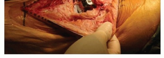 Illustration 4 for Patella Tendon Rupture Reconstruction in Revision TKA