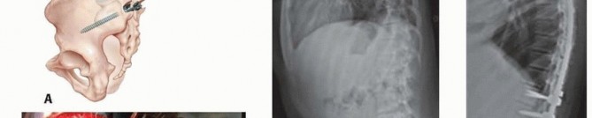 Illustration 33 for Duchenne Muscular Dystrophy: Is Spinal Fusion the Answer?