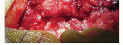 Illustration 19 for Cemented Total Hip: A Successful & Evidence-Based Solution