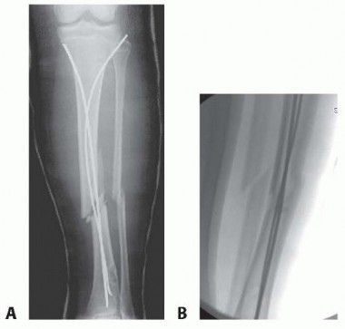 Illustration 16 for Optimal Treatment for Pediatric Tibial Fractures: Key Insights