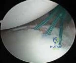 Illustration of shoulder j bone joint - Dr. Mohammed Hutaif