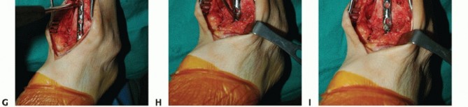 Illustration 24 for Optimize Pain Management with Proximal Ring Block for Ankle Arthrodesis