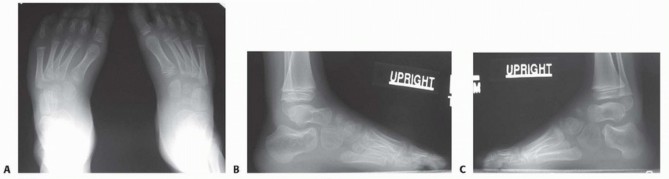 Illustration 9 for Why Anterior Tibialis Muscle Transfer Fixes Clubfoot