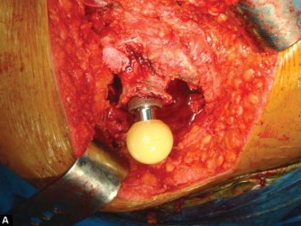 Illustration 66 for The Silent Hip: Achieving a Truly Silent, Pain-Free Joint