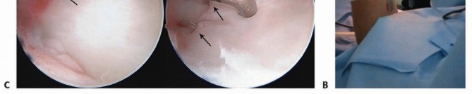 Illustration 20 for Galeazzi DRUJ Stabilization: Unlocking Stability with Smooth Stainless Steel