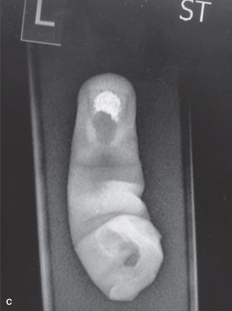 Illustration 2 for Hand Injury Case: Is it Degloving or Complete Amputation?