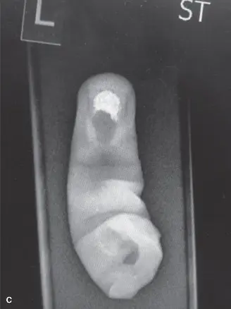 صورة توضيحية لـ إصابات اليد الخطيرة: تمزق الأنسجة (Degloving) والبتر الجزئي – دليل شامل للمرضى