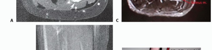Illustration 2 for Soleus Resection for Tumors: Protecting the Heads of the Gastrocnemius