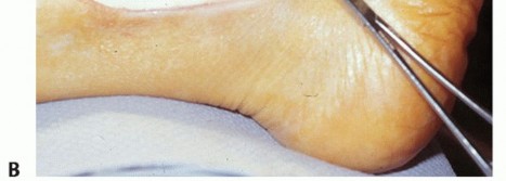 Illustration 4 for Beyond Primary Repair: Solutions for Peroneal Tendon Subluxation