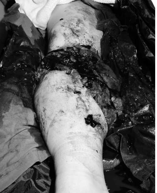 Mangled Extremity Trauma: Critical Decisions & Case Management