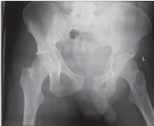 كسور الحوض: دليل شامل للمرضى مع الأستاذ الدكتور محمد هطيف في صنعاء