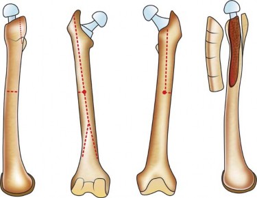 Illustration 7 for Standard Trochanteric Osteotomy: Key to Complex Hip Cases