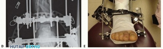 Illustration 6 for Tibia External Fixation: See How Pins Are Placed for Healing