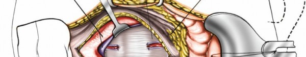 Illustration 27 for Expert Guide: Transperitoneal and Retroperitoneal Lumbar Access