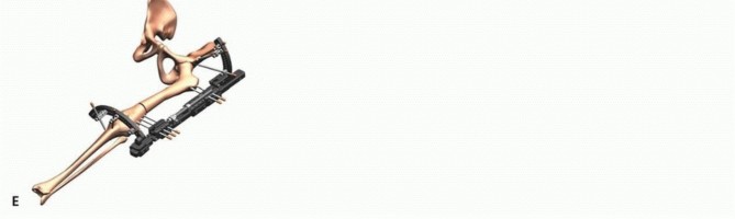 Illustration 51 for Treatment for Congenital Femoral Deficiency: What You Need to Know