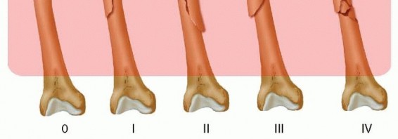 Illustration 6 for Retrograde Femoral Nailing: Optimizing Surgical Outcomes