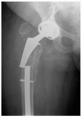 Illustration 7 for Revision THA: Why Extensively Porouscoated Cylindrical Stems Excel