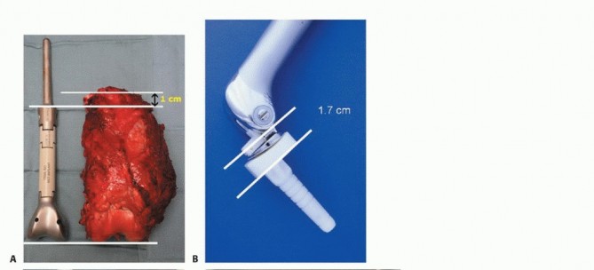 Illustration 42 for Advanced Distal Femoral Resections: Limb-Sparing Outcomes & Techniques