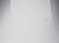 Illustration 73 for Mastering Gap Balancing in Revision TKA: Avoid Common Pitfalls